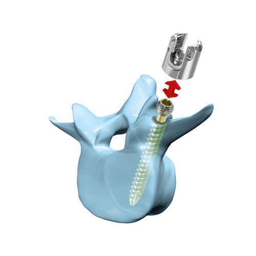 Vite peduncolare lombare - “mediRod®”-Tri - Medicon eG - poliassiale / canalare