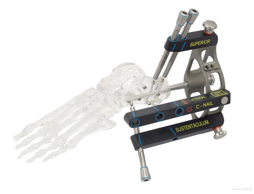 Chiodo intramidollare per calcagno - C-NAIL - MEDIN