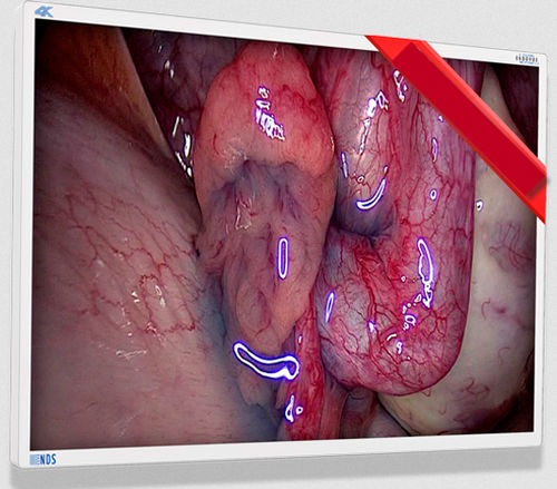 Monitor medico - EndoVue Plus - NDS Surgical Imaging - per endoscopia / ad alta definizione / 55"