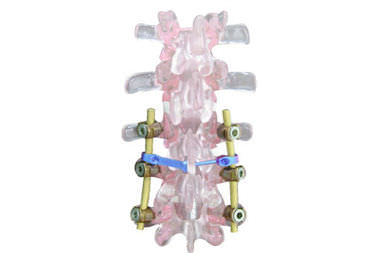 Sistema di osteosintesi cervico-toraco-lombo-sacrale - EVOLUTION PLUS - Ortosintese - via posteriore / per adulti
