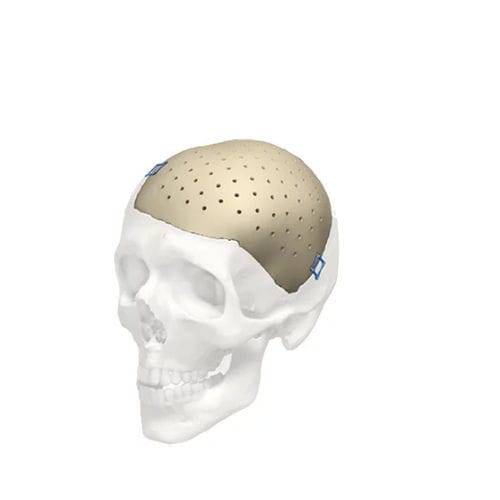 Impianto cranico su misura - Cranial iD - Stryker