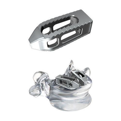 Gabbia intersomatica lombo-sacrale - tezo™ - ulrich medical - via transforaminale / in titanio