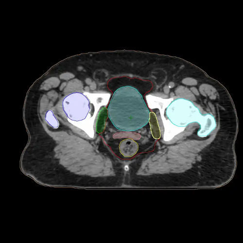 Piattaforma AI medica - Varian Oncology - di riconoscimento dei contorni / di pianificazione del trattamento