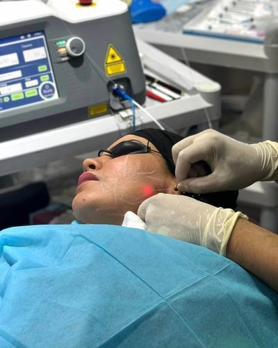 Unità di ringiovanimento cutaneo laser - Endolifting - GIGAALASER - su carrello