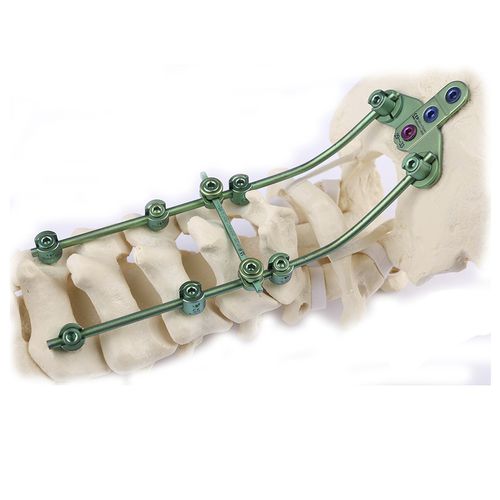 Sistema di osteosintesi occipitocervicale - Double Medical Technology - via posteriore / per adulti