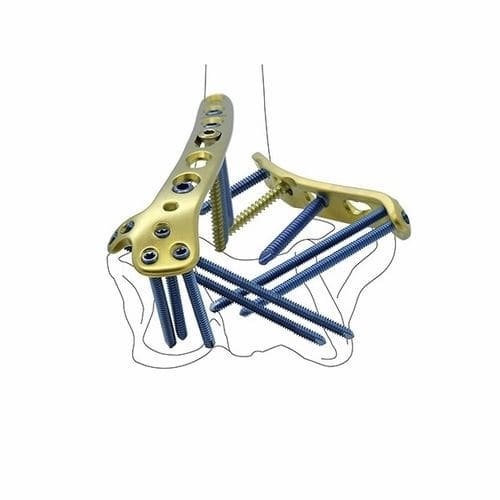 Placca di compressione per omero - Double Medical Technology - distale / mediale / bloccata