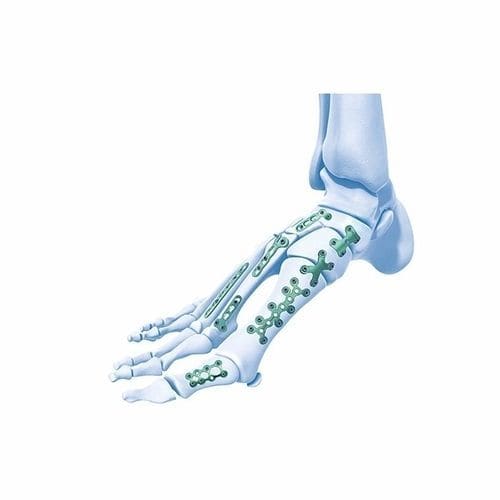 Placca di compressione per metatarso - Double Medical Technology - per falange del piede / per tarso / bloccata