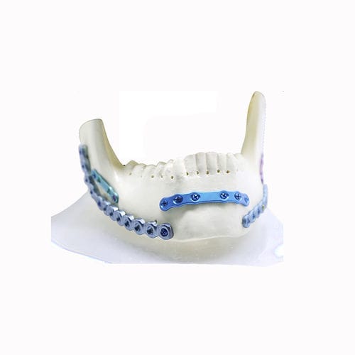 Placca di compressione per mandibola - Double Medical Technology - bloccata