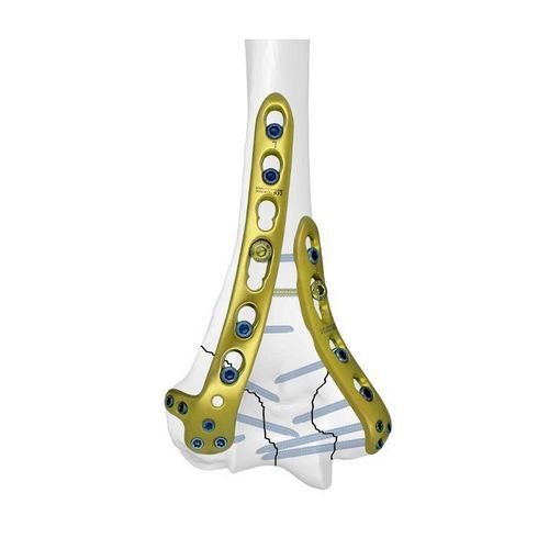 Placca di compressione per omero - Double Medical Technology - distale / bloccata