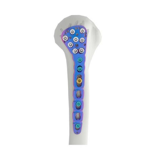 Placca di compressione per omero - VAL - Double Medical Technology - prossimale / bloccata