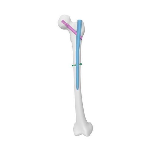 Chiodo intramidollare per femore - APFN Aimstrong - Double Medical Technology - fissazione prossimale / fissazione diafisaria / in acciaio inossidabile