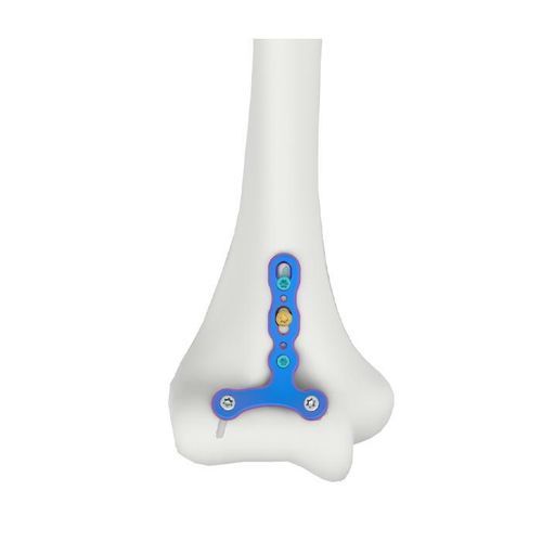 Placca per osteotomia per omero - VAL Humeral Capitellum Trochlea - Double Medical Technology - bloccata