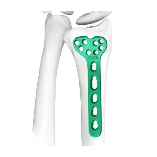 Placca per osteotomia per radio - Double Medical Technology - distale / bloccata / in titanio