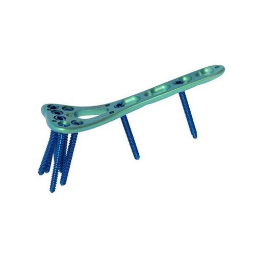 Placca di compressione per radio - Double Medical Technology - distale / bloccata