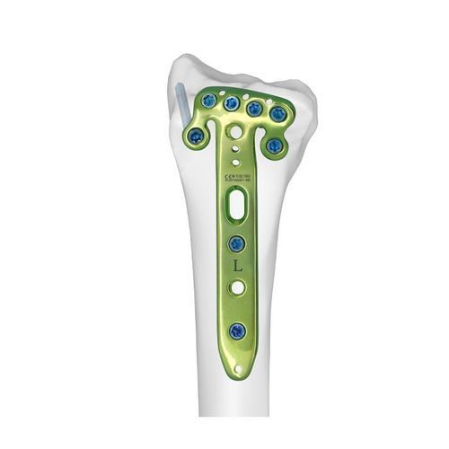 Placca di compressione per radio - Double Medical Technology - distale / bloccata