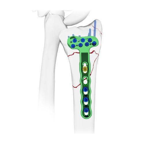 Placca di compressione per radio - Double Medical Technology - distale / bloccata