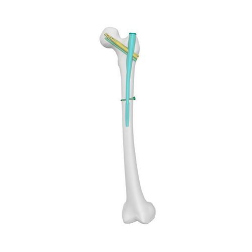 Chiodo intramidollare per femore - PFCN - Double Medical Technology - fissazione prossimale