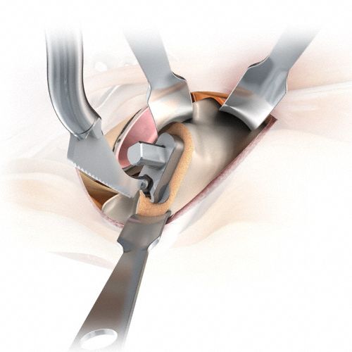 Strumentario chirurgico per chirurgia mininvasiva dell'anca - MIOS&reg; - Aesculap®