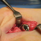 Impianto interfalangeo del piede - HemiCAP DF®  - Arthrosurface