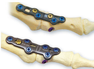 Placca per artrodesi per falange del piede - CheckMATE® - Arthrosurface - non bloccata / in metallo