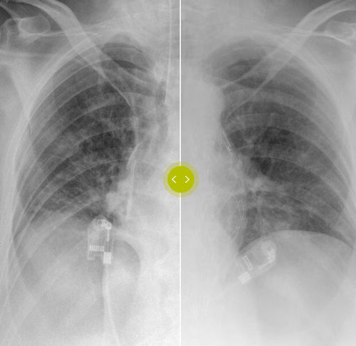 Algoritmo di acquisizione - SkyFlow Plus - Philips Healthcare - di simulazione / di apprendimento automatico / per radiografia