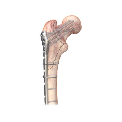 Placca di compressione per femore - PERI LOC PFP - Smith & Nephew - prossimale / bloccata / in acciaio inossidabile