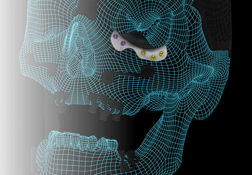 Impianto periorbitale su misura - ORBIT - A.B. Dental Devices