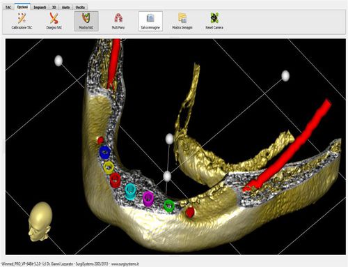 Software di visualizzazione 3D - Winmed - ARTIGLIO SNC   - di pianificazione / chirurgico / per imaging odontoiatrico