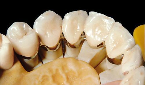 Materiale odontoiatrico in metallo - PontoLloyd® G - BEGO - finitura oro / in lega oro-palladio / per ponti dentali