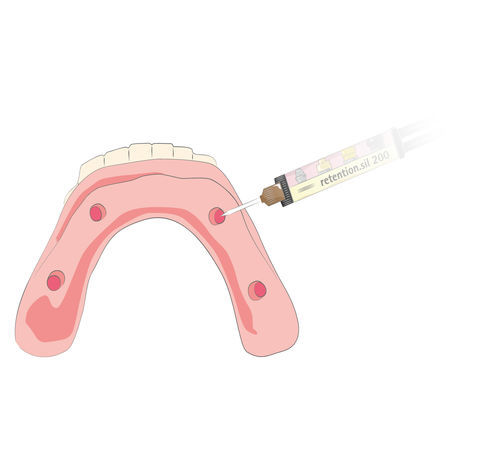 Adesivo dentale per sistemi implantari - retention.sil  - bredent medical - per protesi dentarie