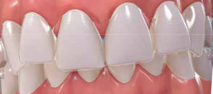Allineatore miofunzionale - Invisalign - Align Technology