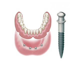 Impianto dentale conico - ATLAS  - DENTATUS AB   - in titanio / esterno / in una fase