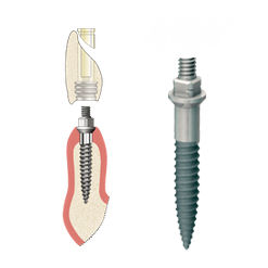 Impianto dentale conico - ANEW  - DENTATUS AB   - in titanio / esterno / stretto