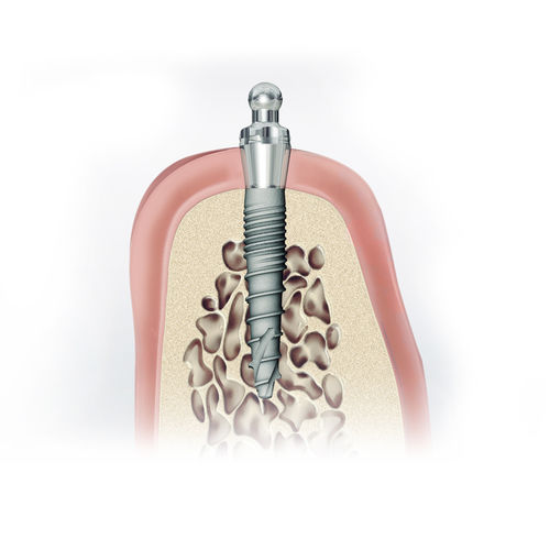 Impianto dentale in titanio - CITO mini® - DENTAURUM - sferico / dritto / monopezzo