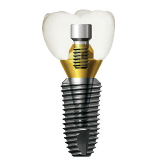 Impianto dentale conico - SuperLine - Dentium - in titanio / ad esagono interno