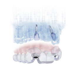 Software di simulazione d'impianto dentale - SIMPLANT® - DENTSPLY Implants GmbH - di pianificazione / per implantologia dentale