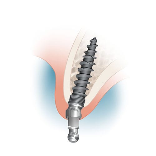 Impianto dentale in titanio - MDL2513A, MDL2515A, MDL2518A - Intra-Lock International, Inc.   - sferico / angolare