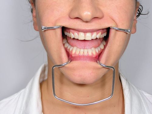 Divaricatore guancia - CRO2 - Jakobi Dental GmbH - odontoiatrico / per adulti / in acciaio inossidabile