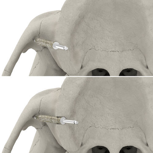 Punta per osteotomia pre-impianto - JDZygoArch  - JDENTALCARE SRL   - in diamante