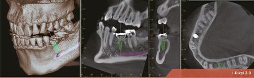 Software per imaging odontoiatrico - i-Dixel 2.0 - Morita