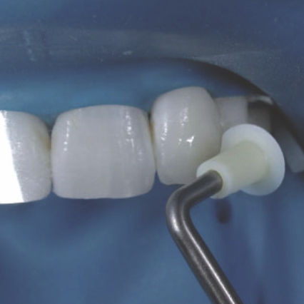 Carver per composito dentale - NA067 - Navadha Enterprises  