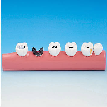 Modello anatomico odontoiatrico - PE-TDS005 - Nissin Dental Products Inc.   - ad uso didattico / di carie