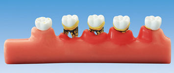 Modello anatomico odontoiatrico - PE-PER010 - Nissin Dental Products Inc.   - di costola / per parodonzia / ad uso didattico