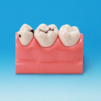 Modello anatomico odontoiatrico - PE-STP008 - Nissin Dental Products Inc.   - ad uso didattico / di carie