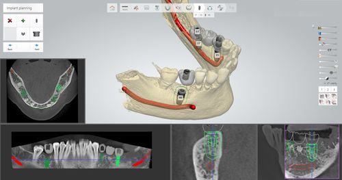 Software di pianificazione - Thommen Medical AG   - per chirurgia guidata / per implantologia dentale