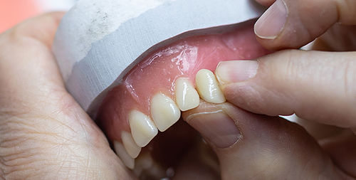 Protesi dentale in composito - VITAPAN®  - VITA Zahnfabrik H. Rauter GmbH & Co.KG   - per denti anteriori