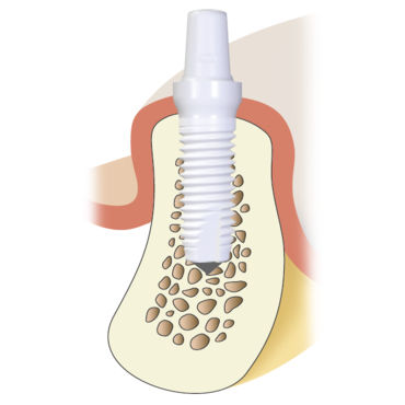 Impianto dentale cilindrico - Z5m - Z-Systems AG   - in ceramica / monopezzo / autofilettante