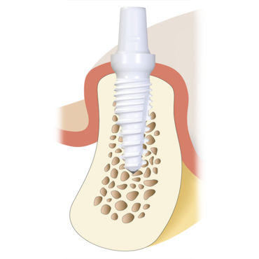 Impianto dentale conico - Z5m(t) - Z-Systems AG   - in ceramica / monopezzo / autofilettante