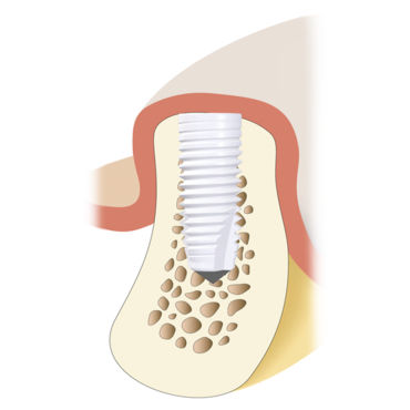 Impianto dentale cilindrico - Z5-BL - Z-Systems AG   - in ceramica / interno / dritto