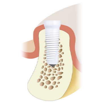 Impianto dentale cilindrico - Z5-TL - Z-Systems AG   - in ceramica / interno / dritto